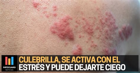 Culebrilla Se Activa Con El Estr S Y Puede Dejarte Ciego