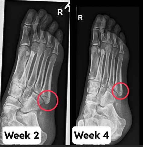 5th Metatarsal Jones Fracture Progress R Brokenbones