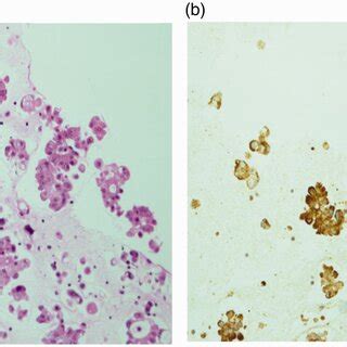 ALK immunohistochemistry performed on a cell block from a pleural ...