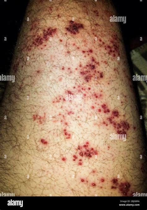 Herpes zoster impfung Fotos und Bildmaterial in hoher Auflösung Alamy