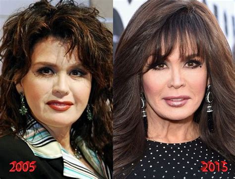 Marie Osmond’s Before and After Photos Show Her Various Facets | Dirty ...