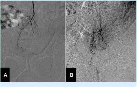 Figure 1 From An Overview Of Endovascular Treatment For Hemorrhoidal