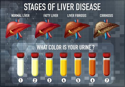 Stages of liver disease stock illustration. Illustration of fibrosis ...