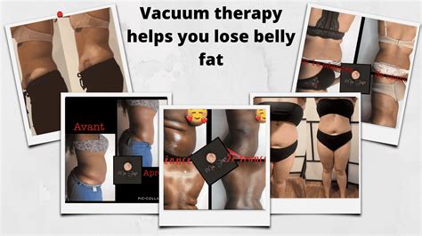 Vacuum Therapy For Weight Loss: Belly Fat & Hip Dips - Bella Vacuum