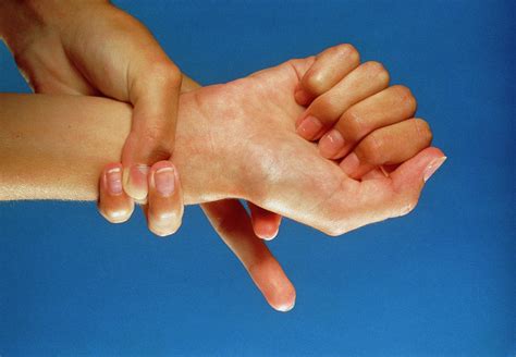 Marfan's Syndrome: Joint Laxity And Long Fingers Photograph by Science ...