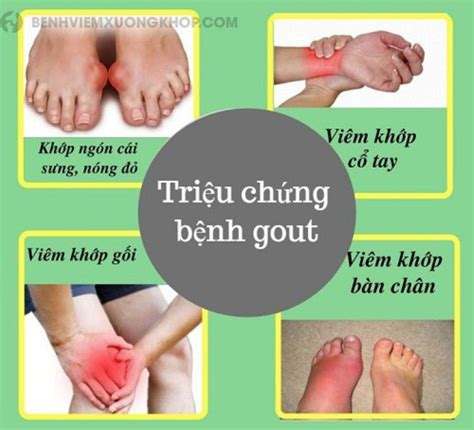 Chẩn đoán bệnh gout qua dấu hiệu bệnh gout dấu hiệu