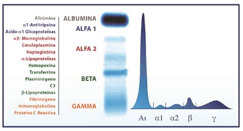 Eletroforese De Proteinas Normal