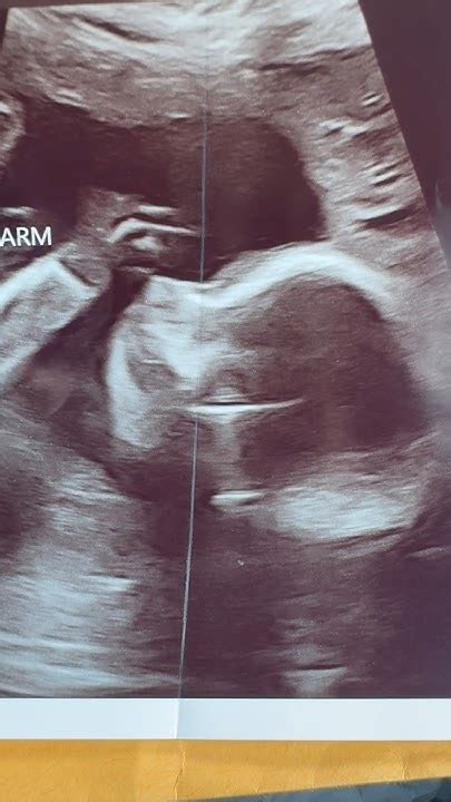 Follow Up Baby Anatomy Scan Ultrasound 23 Weeks Pregnant