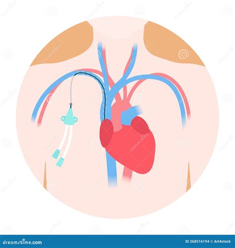 Tunneled Central Line Venous Catheter Medical Diagram Stock Vector