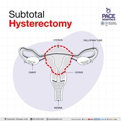 Recovery After Partial Hysterectomy