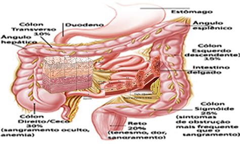 Cancer De Colon E Reto - Cancer Colorretal - COLONOSCOPIA - COLOPROCTOLOGIA - ENDOSCOPIA