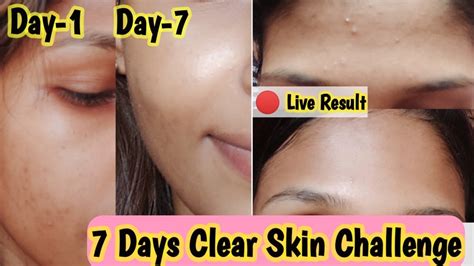 How To Get Clear Skin Within 7 Days I Followed 7 Days Challenge Clear Skin Challenge