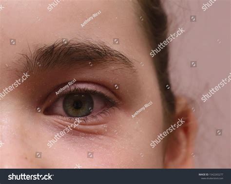 Eyelid Eczema Atopic Dermatitis Allergic Female Stock Photo Edit Now