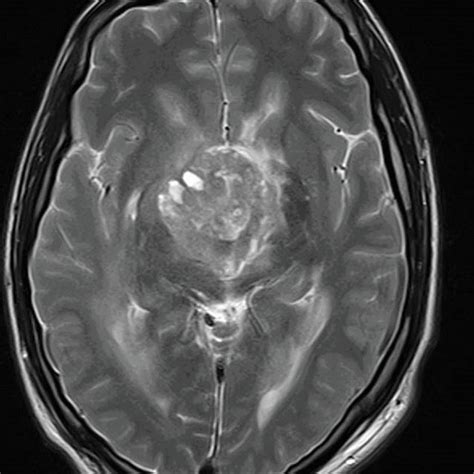 Glioblastoma Mri Exhibiting A Solid Cystic Lesion Which Determined