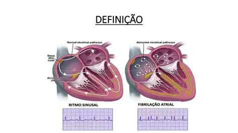 Fibrilação Atrial E Flutter Atrial