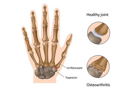 Thumb Basal Joint Arthritis Arthroplasty Montreal Toronto Ottawa