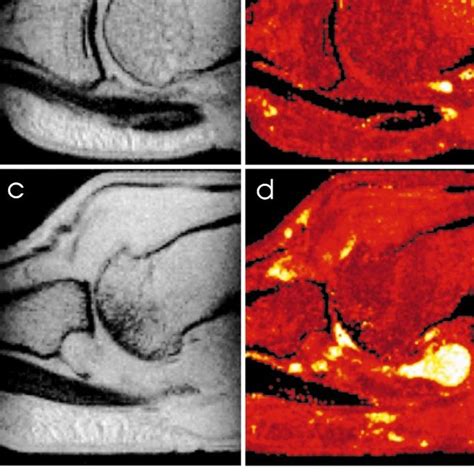 Pdf Magnetic Resonance Imaging Of Rheumatoid Arthritis In Metacarpophalangeal Joints