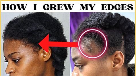 Regrow Your Edges And Baldspots The Natural Way Youtube