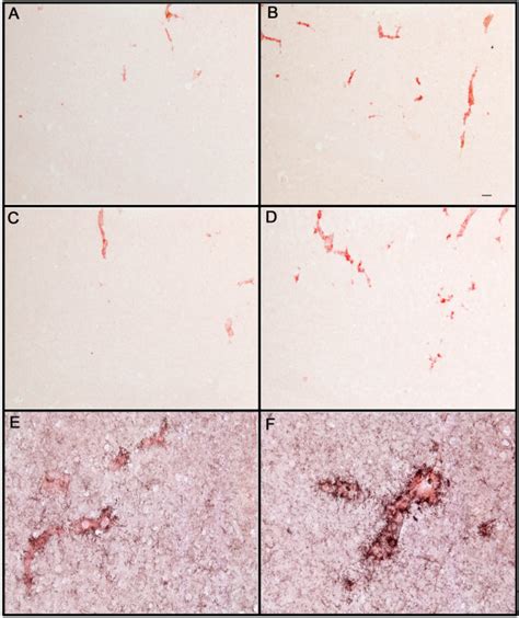 Increased Congo Red Staining Of Blood Vessels Following Anti Aβ