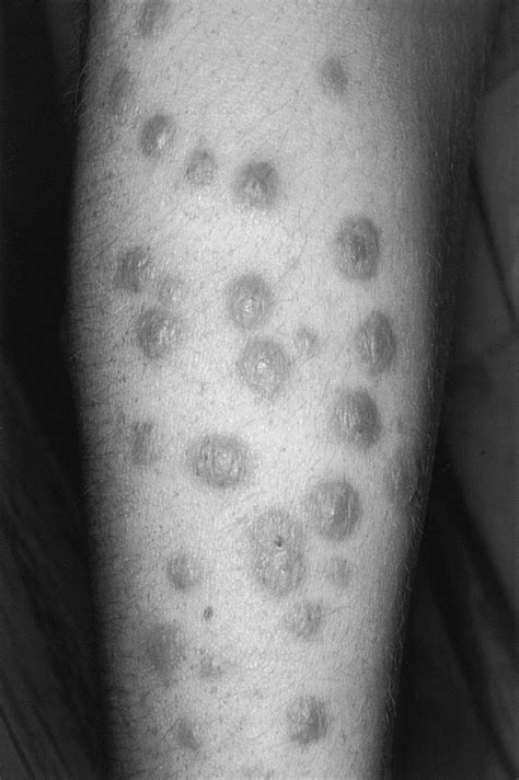 Pustular Eruptions In Systemic Disease Clinics In Dermatology