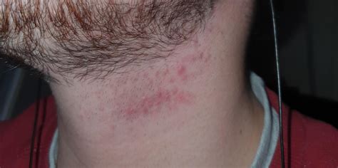 Red Spots On My Neck