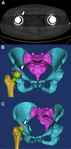 Factors Influencing Noise Following Primary Ceramic On Ceramic Total Hip Arthroplasty The