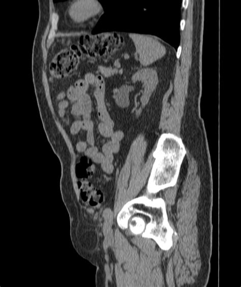 Radiopaedia Case Urinary Bladder Hernia Id Study Nc Commons