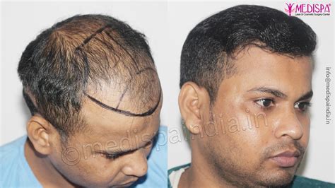 Best Hair Restoration Results Delhi Hair Transplant Dubai Cost