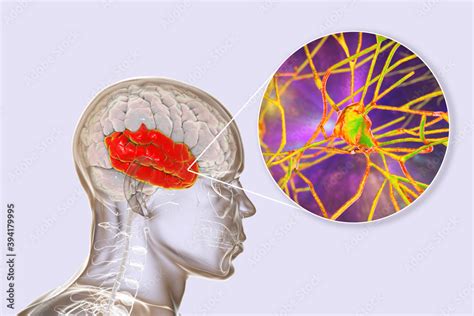 Human Brain With Highlighted Temporal Lobe And Close Up View Of Neurons