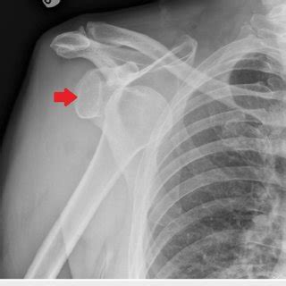 Anteroposterior Radiograph Of The Right Shoulder The Arrow Indicates