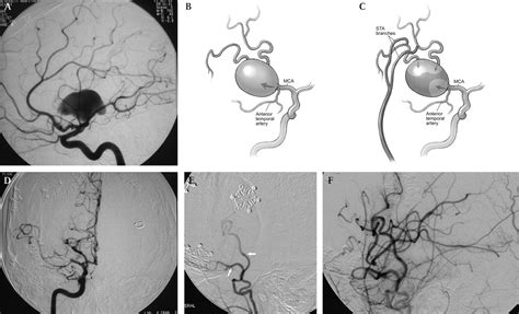 Cerebral Revascularization For Ischemic Disease In The 21st Century