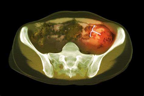 Ectopic Iud Contraceptive Ct Scan Photograph By Du Cane Medical