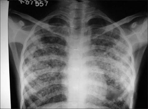 Pulmonary Edema Chest X Ray