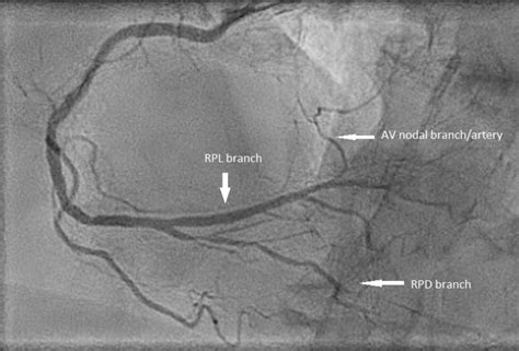 Coronary Angiography Of The Right Coronary Artery Shows The Typical