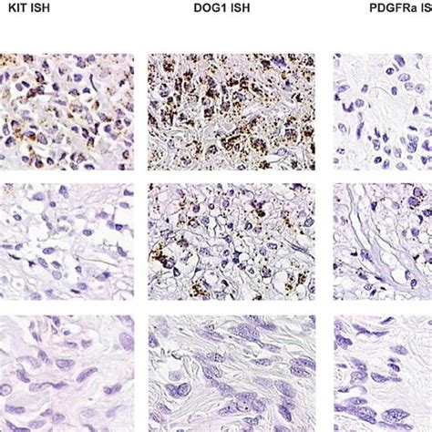 Staining Results On Gists For Cd117 Kit Immunohistochemistry Cd117 Download Scientific