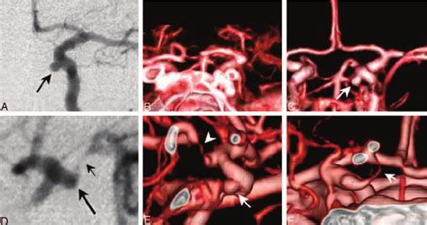 Case 8 Patient With 1 Carotid Cave Aneurysm And Infundibular Widening Download Scientific