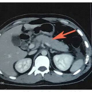 CT Abdomen Showing Pancreatic Inflammation Highlighted By The Red