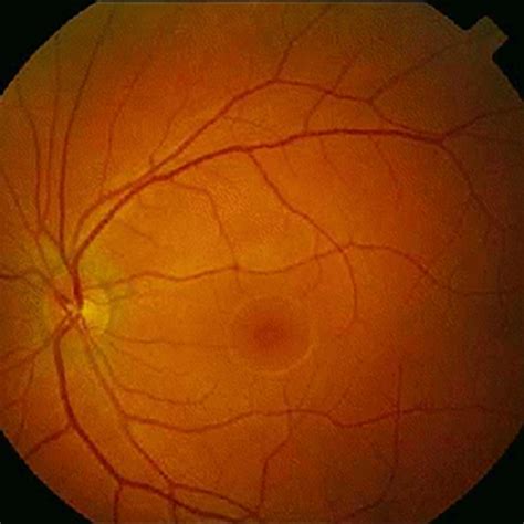 NETZHAUT Retina Augenarzt Wuppertal