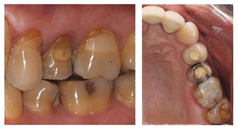 Revista Canal Abierto Management Of A Cyst Of Apical Origin With Non