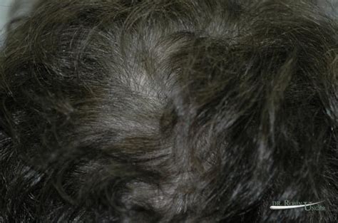 Treatment to hair thinning in the vertex | Dr. Unger | Dr. Robin Unger | Hair Transplant Specialist