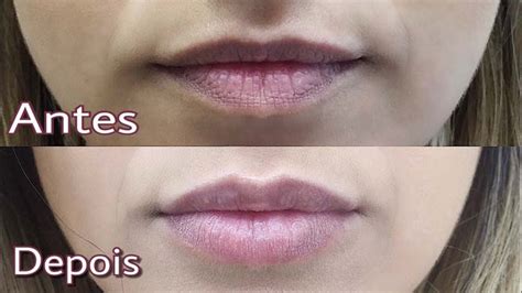 Preenchimento Labial Definitivo Preço Antes E Depois Dói