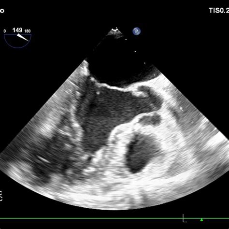 Preoperative Transesophageal Echocardiography Download Scientific Diagram