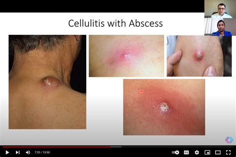 Diagnosis And Treatment Of Cellulitis Mdstewardship