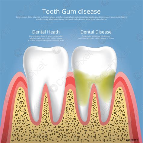 Human Teeth Stages Of Gum Disease Vector Illustration Stock Vector