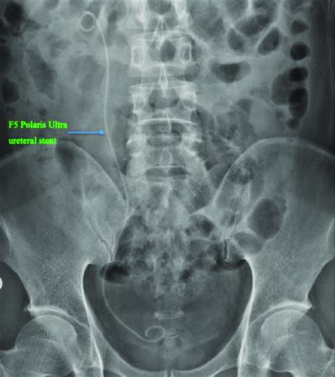 An X Ray Of Patient 2 Showing That An F5 Polaris Ultra Ureteral Stent