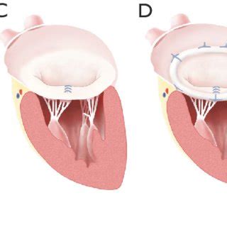 Illustrations Showing Resection Technique Of Mitral Valve Repair