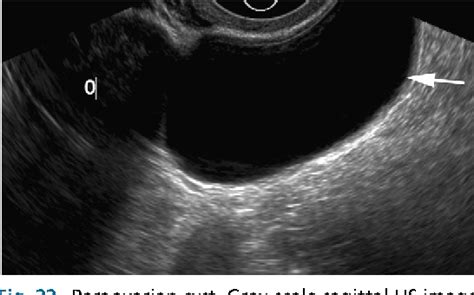 Figure 1 From Ultrasonography Evaluation Of Pelvic Masses Semantic