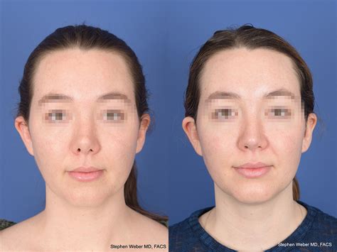 Revision Rhinoplasty Before And After Weber Facial Plastic Surgery