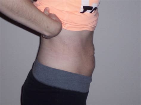 Amazing Hernia Reversal And Diastasis Recti Repair During 4 Week