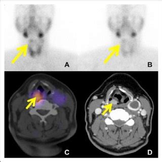 A M Tc Sestamibi Scintigraphy Demonstrating Increased Uptake On